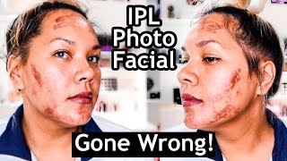 IPL Photofacial Before And After  I WONT DO THIS AGAIN [upl. by Adina445]