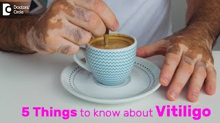 Vitiligo Types Symptoms Causes Treatment amp Recovery  Dr Divya Sharma  Doctors Circle [upl. by Henarat574]