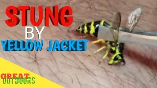 Stung by a Yellow jacket [upl. by Walls]