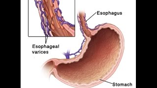 Esophageal Varices [upl. by Norah]