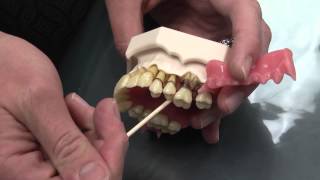 What is Periodontal Disease [upl. by Airaet]