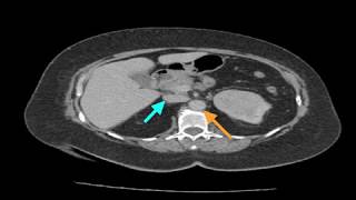 Clinical Case Renal Cell Carcinoma [upl. by Savannah]