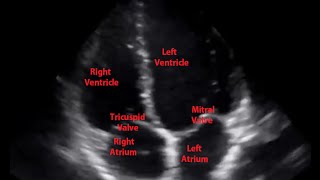 Intro to EKG Interpretation  Chamber Enlargement [upl. by Mar]