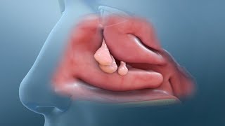 Nasal Polyp Removal Surgery [upl. by Ahseei493]