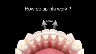 How Do Dental Splints Work [upl. by Ladiv236]