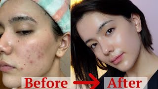 how I got rid of my ACNE after 8 years  ONLY thing worked [upl. by Toille]