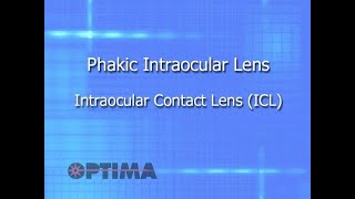 Phakic Intraocular Lens – Intraocular Contact Lens ICL [upl. by Newcomb]