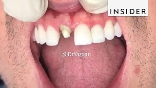 How Dentists Create Tooth Veneers And Crowns [upl. by Adnawat378]