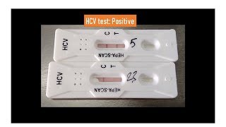 HCV test positive Test yourself at home [upl. by Netsreik]