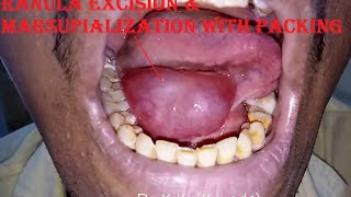 Ranula Excision amp Marsupialization with Packing [upl. by Zetrauq151]