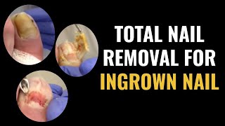 Total Nail Removal For Ingrown Toenail [upl. by Aicelef]