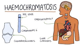 Understanding Haemochromatosis [upl. by Assirral]