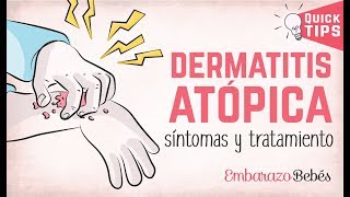 🚨😣 PIEL ATÓPICA en Bebés y Niños Cómo cuidar y tratar el Brote de Dermatitis atópica [upl. by Vivl]