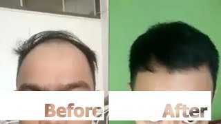 Review Neo Hair Lotion Hair Growth and Hair Root Nourishment Spray [upl. by Nidnal]