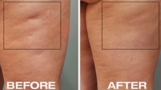 New tool to fight cellulite [upl. by Aihsema409]