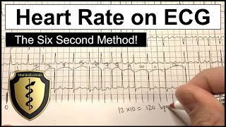 EKG l Atrial Fibrillation A Fib [upl. by Aridaj]