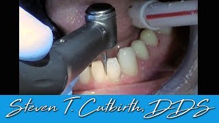 Prepping Teeth for Lower Veneers  Dental Minute with Steven T Cutbirth DDS [upl. by Akimak724]