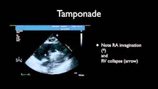 Tamponade amp Pericardiocentesis [upl. by Appleton]