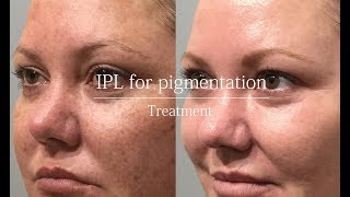 IPL for pigmentation  treatment video [upl. by Laohcin]