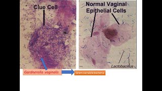 Clue cells under the Microscope [upl. by Ennaj]