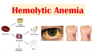 Hemolytic Anemia [upl. by Gard934]