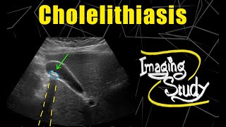 Cholelithiasis  Gallstone  Ultrasound  Case 94 [upl. by Enra]