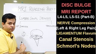 Herniated disc MRI How to read MRI lumbar spine Nerve compression L4L5 L5S1 Canal Stenosis [upl. by Olshausen870]