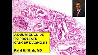 A Dummies Guide to Prostate Cancer Diagnosis [upl. by Rosenblast]