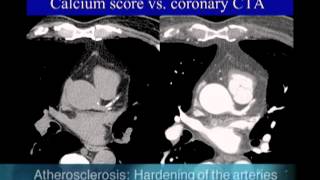 Protocol for Calcified Plaque in Your Arteries – Atherosclerosis – DrBerg [upl. by Edison]