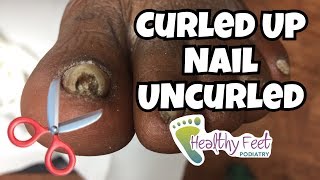 Curled Up Ingrown Nail Uncurled Ingrown Nail Removal [upl. by Getraer]