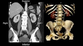 Normal Renal Anatomy [upl. by Oir]