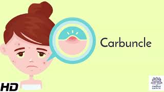 Carbuncle Causes Signs and Symptoms Diagnosis and Treatment [upl. by Reiner]