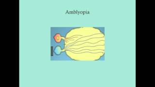 Difference between Myopia Near Sightedness amp Hyperopia FarSightedness [upl. by Adnilav99]