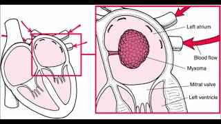 Left atrial myxoma [upl. by Batchelor]