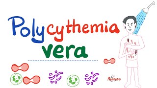 Polycythemia Vera PV  Myeloproliferative Neoplasm MPN  Erythrocytosis  Hematology [upl. by Christoffer]