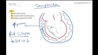 Cardiac Tamponade  Dr Jamal USMLE [upl. by Heller]