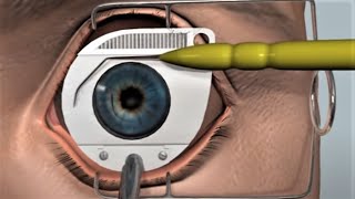 LASIK eye surgery  3D animation [upl. by Antoine759]