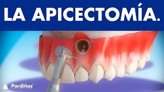 Apicectomía  Tratamiento infección de la raíz del diente © [upl. by Htes]