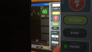 Transcutaneous Pacing TCP [upl. by Nyrok]