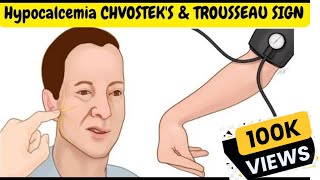 Hypocalcemia Signs and Symptoms  CHVOSTEKS amp TROUSSEAU SIGN [upl. by Dara]