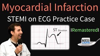 Myocardial Infarction  STEMI on ECG  Practice EKG [upl. by Kamat58]