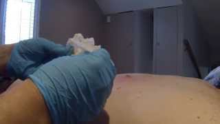 Furuncle Huge CYST DIY Extraction PART 1 [upl. by Yelwar]