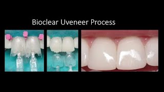 Direct Composite Veneers using the Bioclear Uveneer Process [upl. by Doralin]