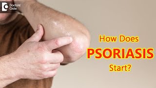 How does psoriasis start Main Causes amp Symptoms  Dr Chaithanya K S  Doctors Circle [upl. by Sadowski]