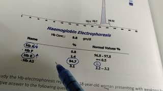 HbE disease question solving [upl. by Htrap]