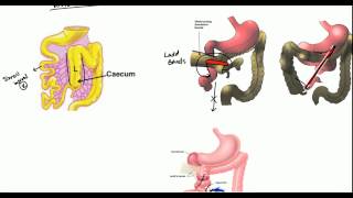 Cases in Radiology Episode 6 abdominal emergency xray CT [upl. by Naharba876]