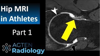 MRI of hip injuries in Athletes  Part 1 [upl. by Atte]