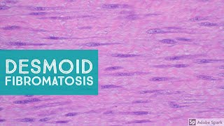 Desmoid Fibromatosis Desmoid Tumor  Explained by a Soft Tissue Pathologist [upl. by Diahann293]