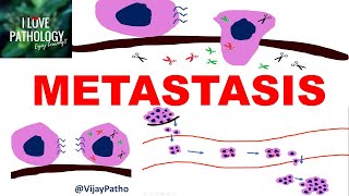 NEOPLASIA 8 INVASION AND METASTASIS Mechanisms Pathways of Spread [upl. by Jovi]