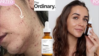 JAK POZBYŁAM SIE TRĄDZIKU  RETINOL z THE ORDINARY oczyścił moją skórę w 3 miesiące [upl. by Yelhs323]